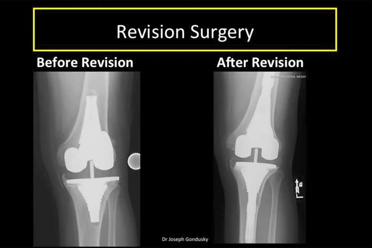 Knee Replacement Revision: Why, How and What to Expect