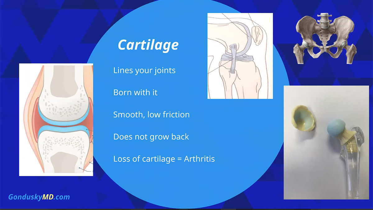 What is Arthritis? Learn about cartilage, joint pain, hip pain, knee pain and joint arthritis 