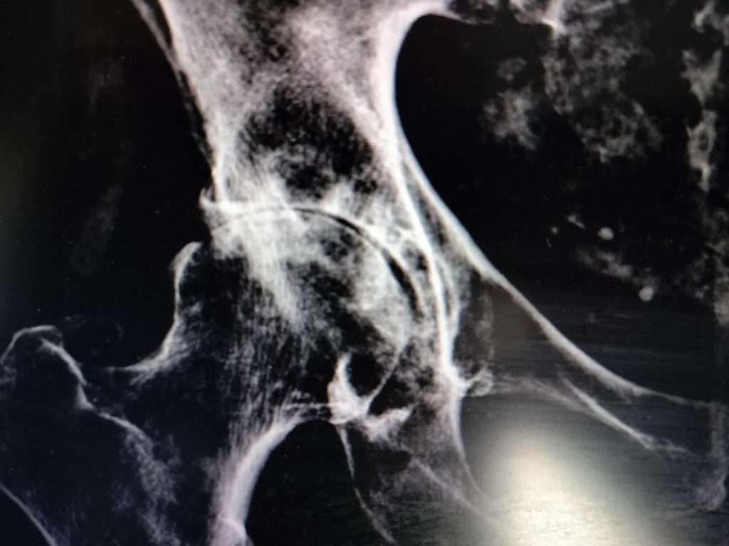 Bone on Bone Right Hip