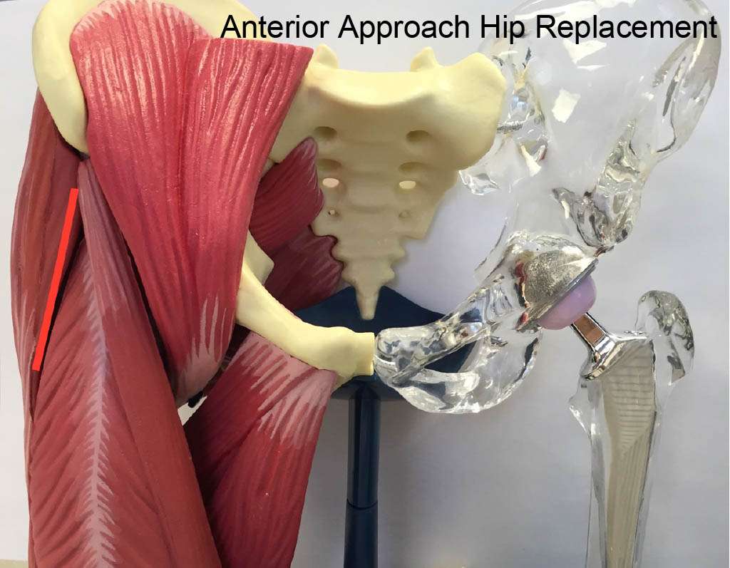 minimally invasive anterior approach hip replacement