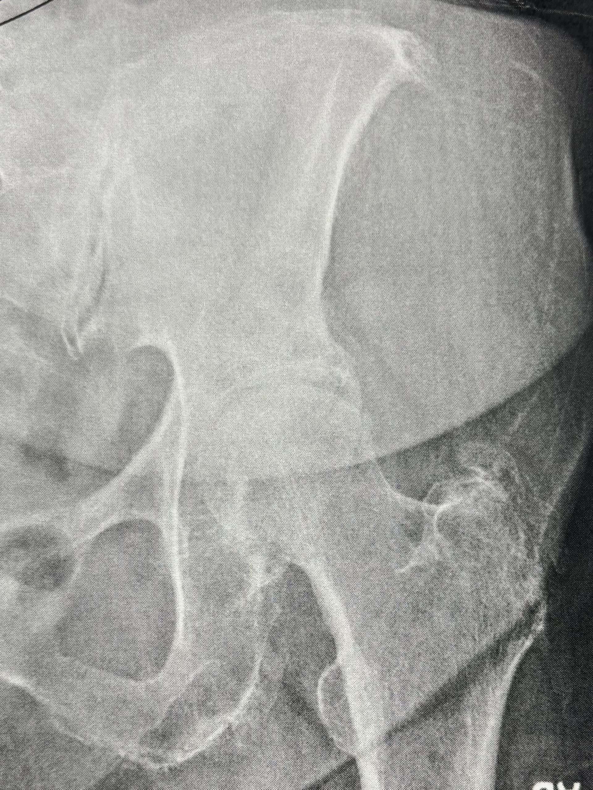 Hip joint x-ray