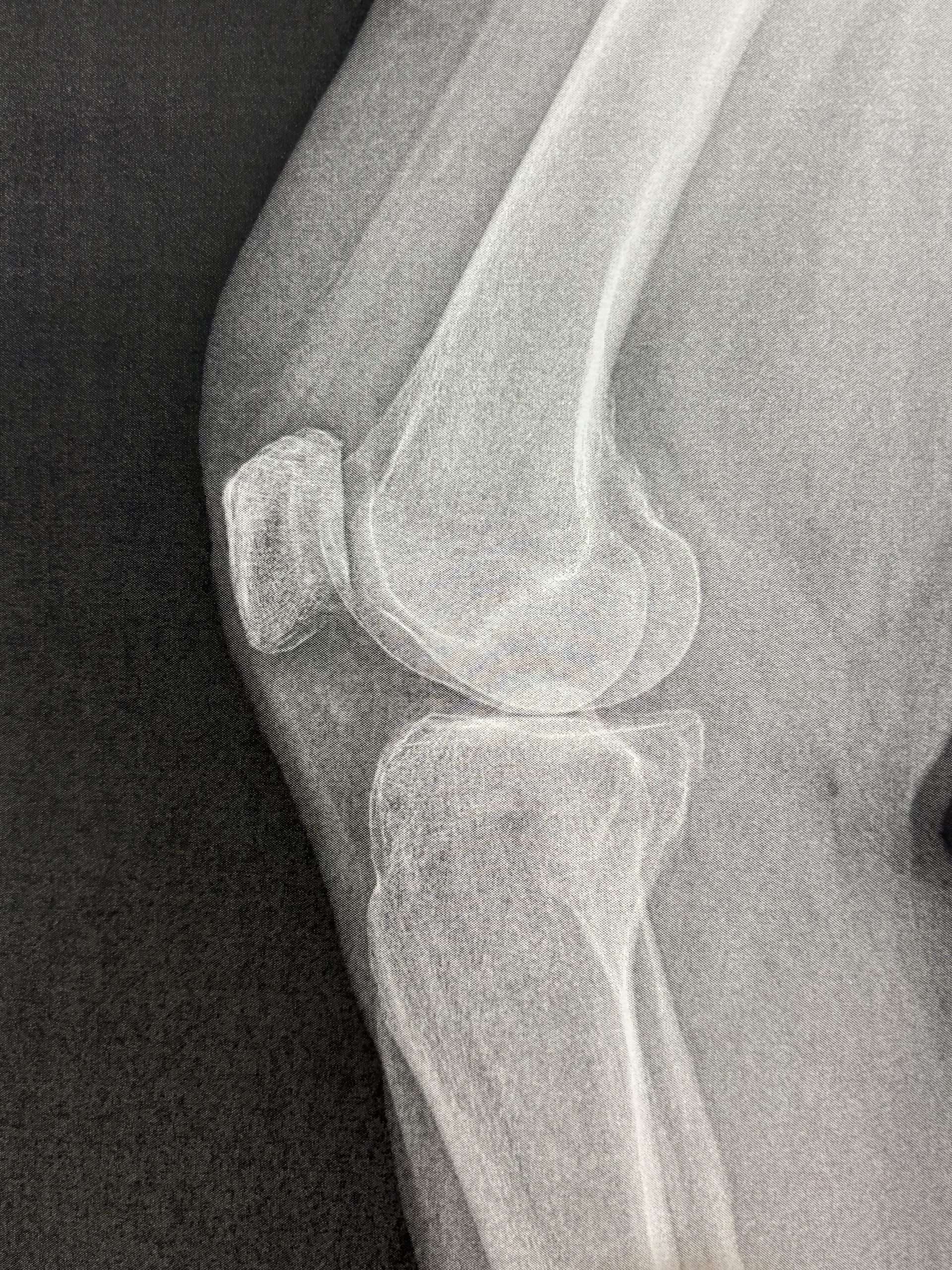 Knee joint x-ray