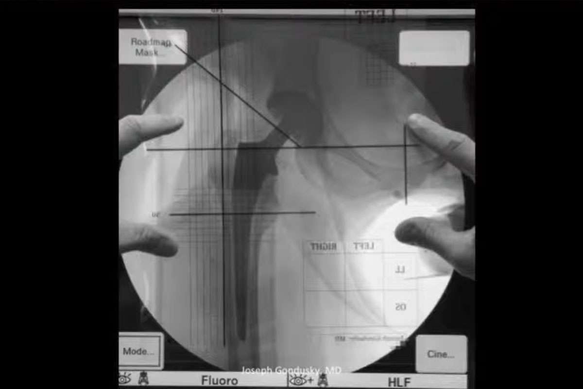Perfecting Component Placement in Anterior Approach Total Hip Arthroplasty